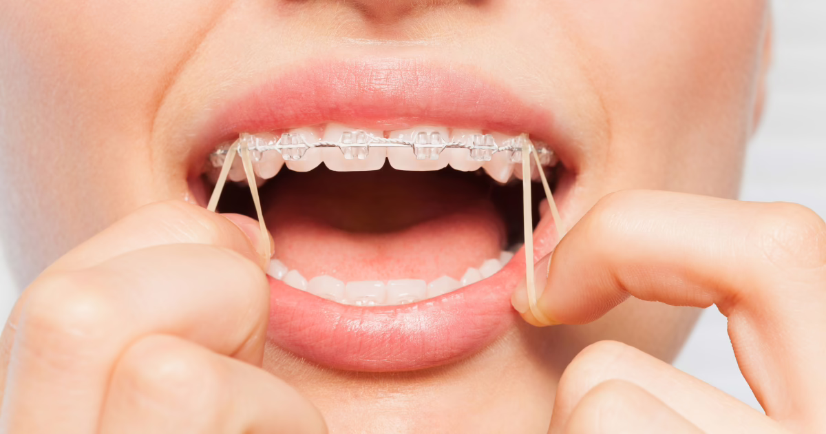 Close-up of person hooking braces rubber bands onto their teeth from top to bottom, Buttram Orthodontics in Panama City